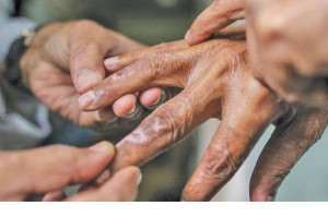 தொழுநோய் மறைக்க வேண்டிய நோய் அல்ல – தொழுநோயை வென்ற ஒரு குடும்பத்தின் உண்மை கதை