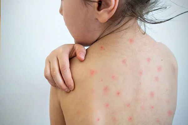 தட்டம்மை தொடர்பில் கனடாவிற்கு விடுக்கப்பட்டுள்ள எச்சரிக்கை