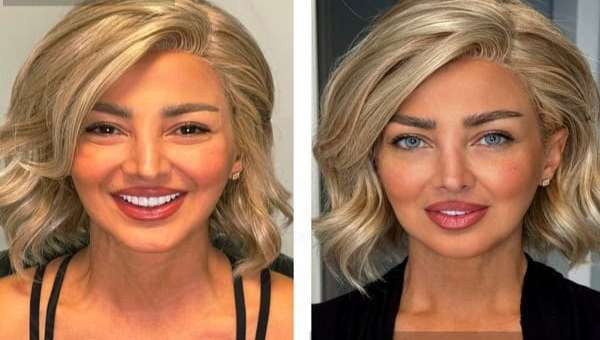 கண் நிறத்தை மாற்றும்  அறுவை சிகிச்சை அதிகரிப்பு!