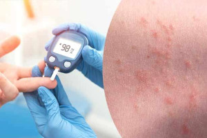  வியர்க்குரு பிரச்சனை சர்க்கரை நோயாளிகளுக்கு அதிகம் வருமா?