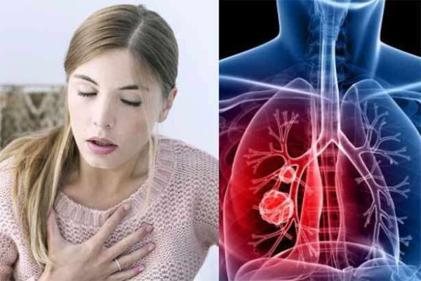 புகை பிடிக்காதவர்களுக்கு நுரையீரல் புற்றுநோய் வருமா?