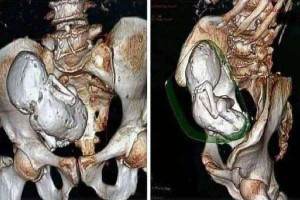 30 வருடங்களாக பெண் வயிற்றில் இருந்த சிசு - கல்லாக மாறிய அதிசய நிகழ்வு