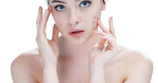 முகப்பருக்களுக்கு நிரந்தர சிகிச்சை