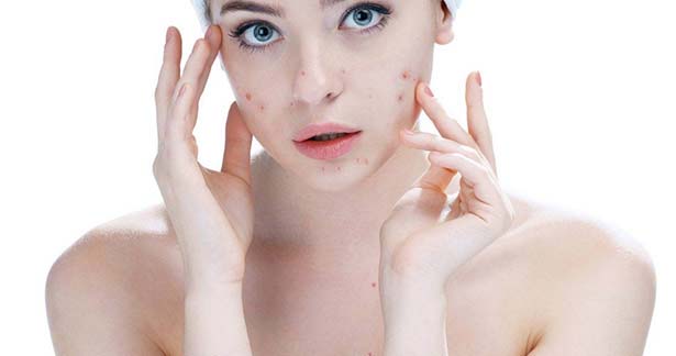 முகப்பருக்களுக்கு நிரந்தர சிகிச்சை