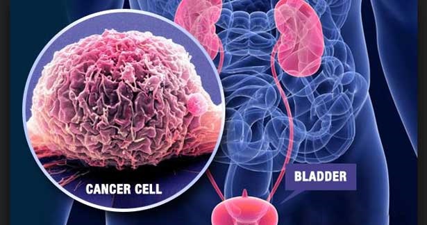 சிறுநீர்ப்பை புற்றுநோயின் அறிகுறிகள்